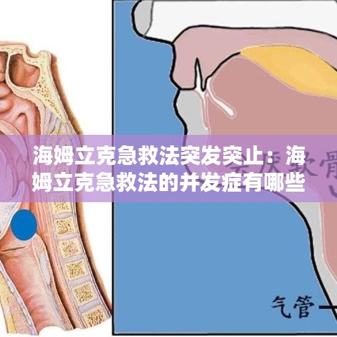 海姆立克急救法突發(fā)突止：海姆立克急救法的并發(fā)癥有哪些? 