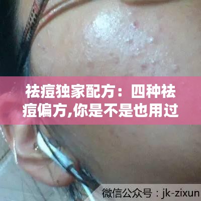 祛痘獨(dú)家配方：四種祛痘偏方,你是不是也用過(guò) 