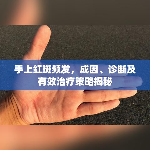 手上紅斑頻發(fā)，成因、診斷及有效治療策略揭秘
