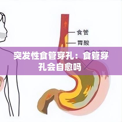 突發(fā)性食管穿孔：食管穿孔會自愈嗎 