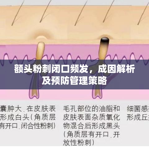 額頭粉刺閉口頻發(fā)，成因解析及預(yù)防管理策略